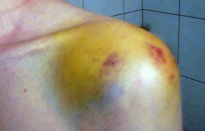 looking colourful after a couple of days!