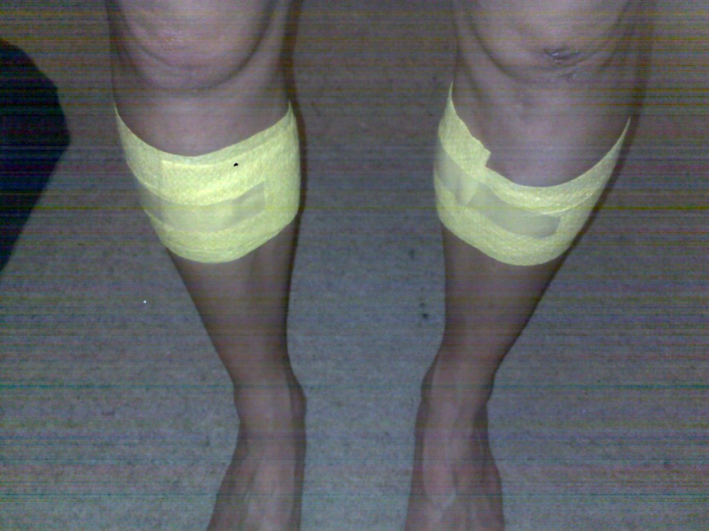 bandaged up after the pressure test